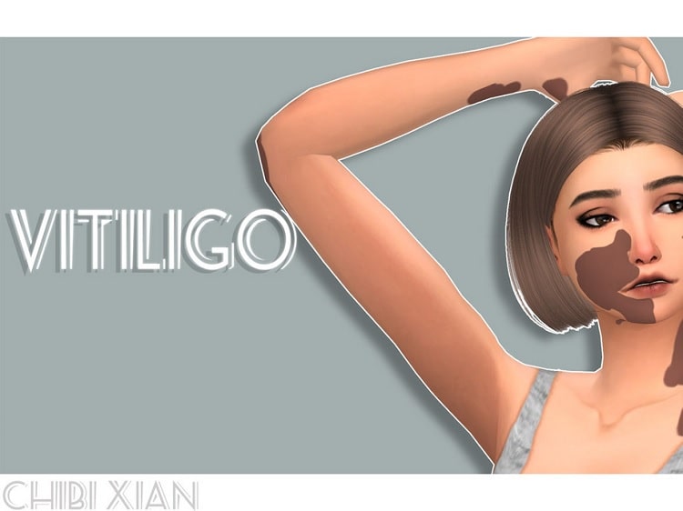 Chibi Xian - Vitiligo Skin