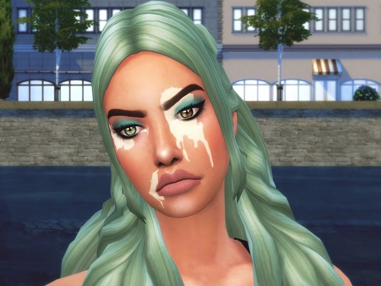 Manila Vitiligo Skin