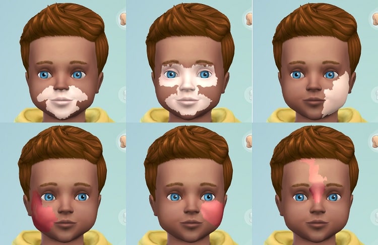 Port Wine Stain and Face Marks for Toddlers