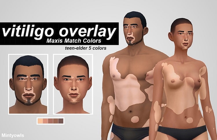 Vitiligo Overlays