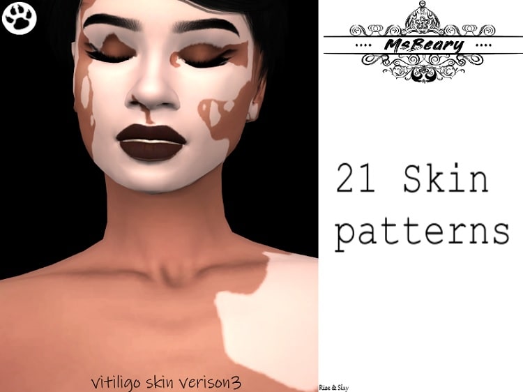 Vitiligo Skin V3 by MsBeary