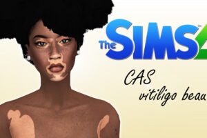 Sims 4 Vitiligo Skin CC & Mods